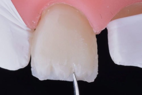 carillas-de-composite-resina-en-barcelona