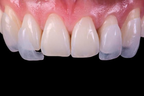 micro-carillas-dentales-sin-tallado-en-barcelona