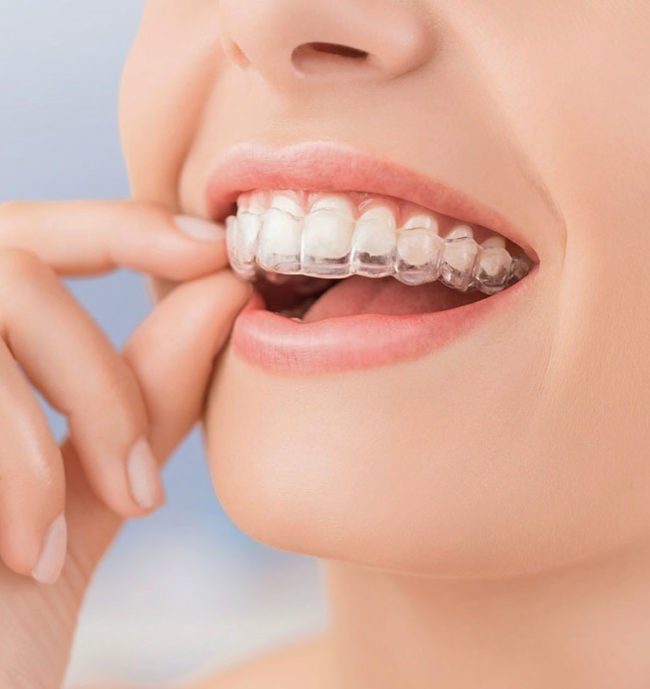 ortodoncia-invisible-invisalign-barcelona