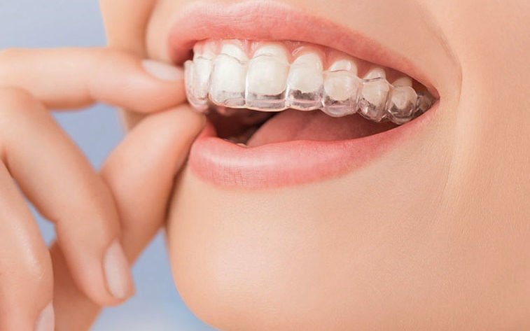 ortodoncia-invisible-invisalign-barcelona