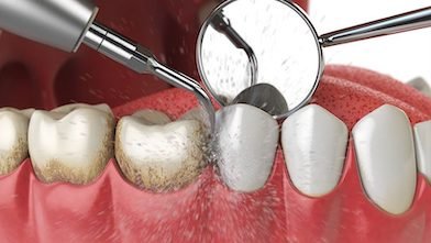 01-limpieza-dental-profesional-o-profilaxis-en-barcelona-clinica-dental-vas-02