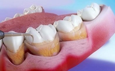 02-que-es-el-raspado-y-alisado-radicular-curetaje-dental-02