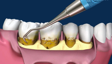 03-cirugia-periodontal