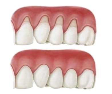 04-injerto-gingival-o-injerto-de-encia-03