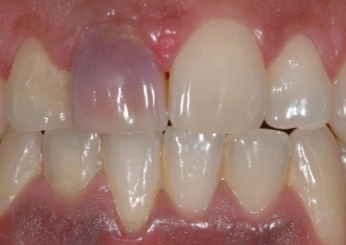 blanqueamiento-de-diente-no-vital