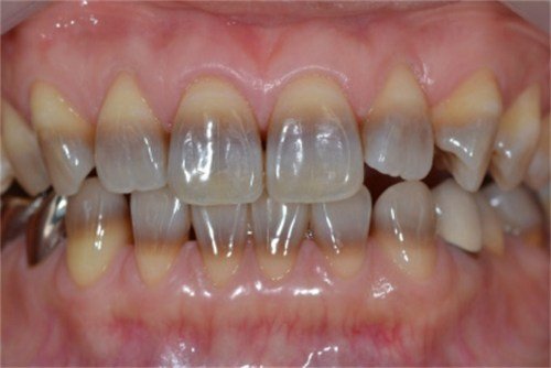 blanqueamiento-dientes-manchados-por-tetraciclinas