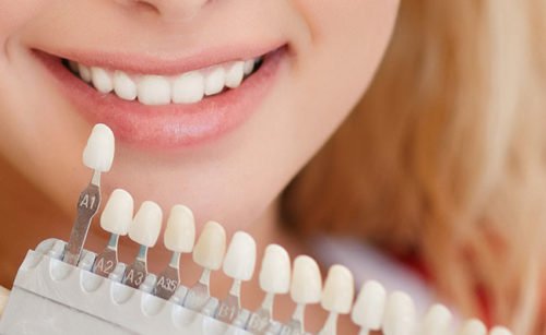 blanqueamiento-previo-a-tratamiento-de-carillas