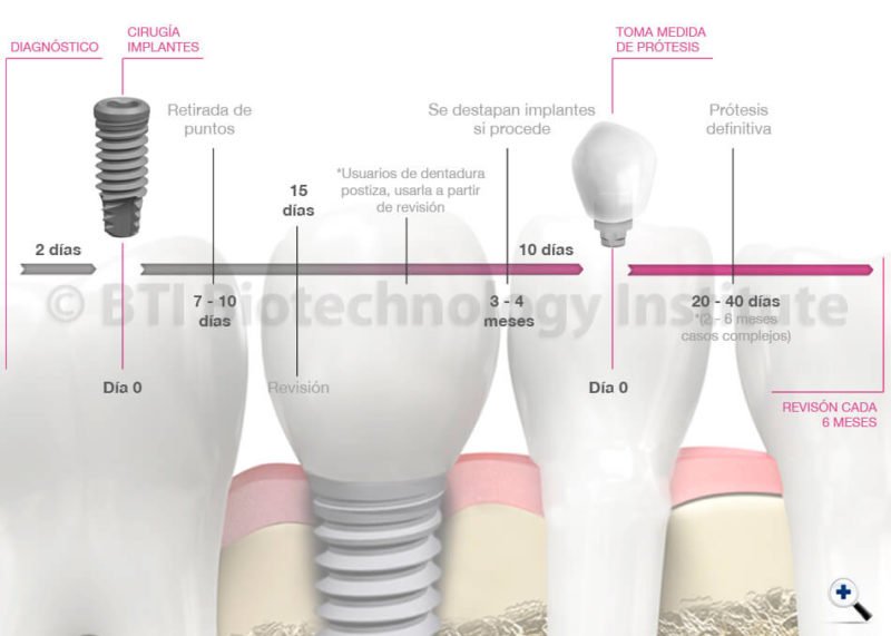fases-tratamiento-implantes-dental-vas
