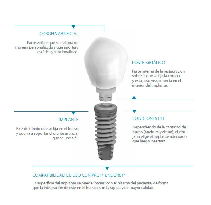 que-es-un-implante