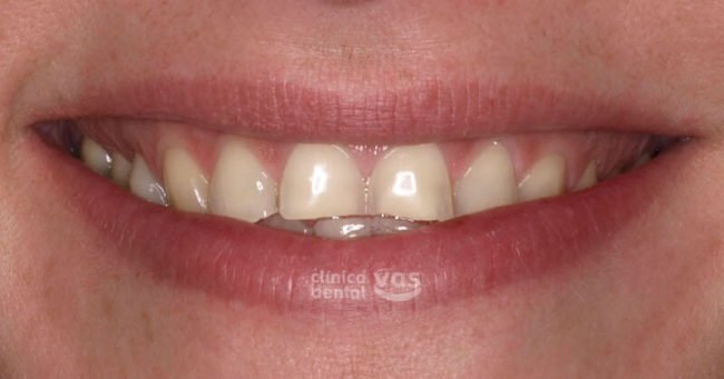 carillas-dentales-lumineers-barcelona-002-antes