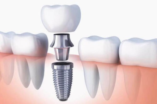 cirugía-oral-colocación-de-implantes-dentales