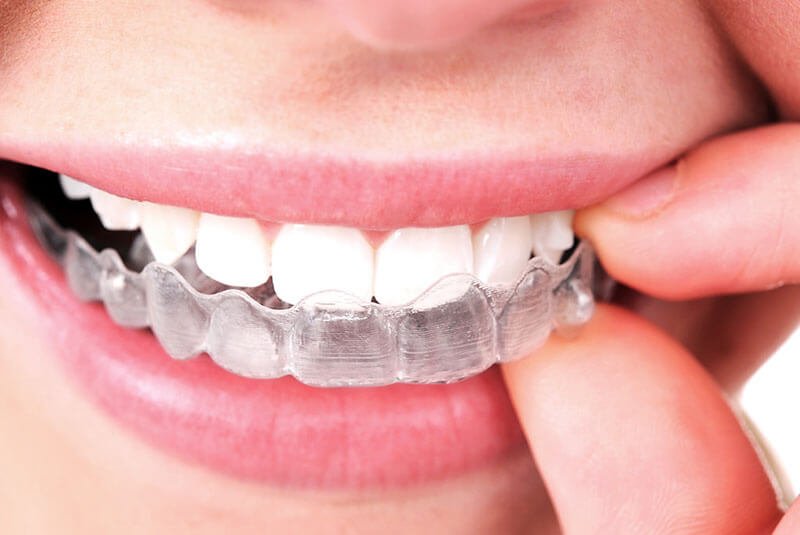 ortodoncia-invisible-invisalign-en-barcelona-tratamientos-clinica-dental-vas-ok