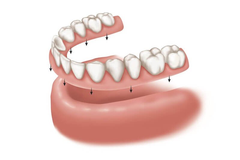 prótesis-dental-completa-o-dentadura-postiza-en-barcelona