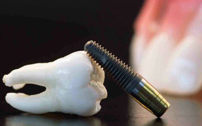 implantes-dentales-en-barcelona
