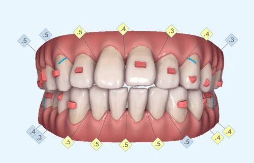 clincheck-ortodoncia-clinica-dental-vas
