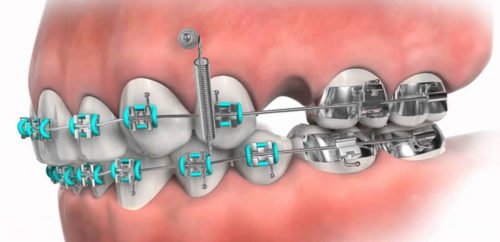 microtornillos-ortodoncia-microimplantes