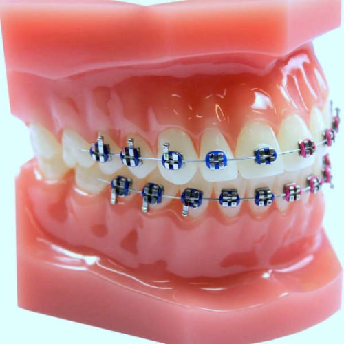 ortodoncia-brackets-metálicos-tradicionales
