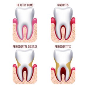 periodoncia-problemas-encias