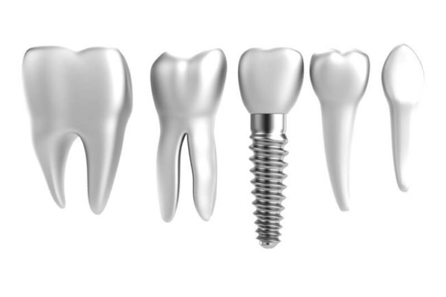 tipos-de-implantes-dentales-barcelona-sant-elies