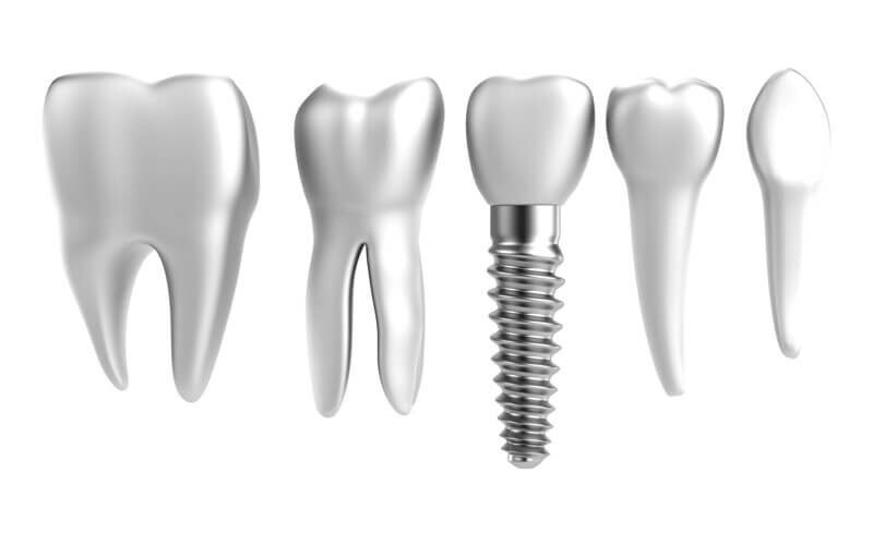 tipos-de-implantes-dentales-barcelona-sant-elies